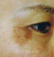 laser pigmentation before (180)(copy)